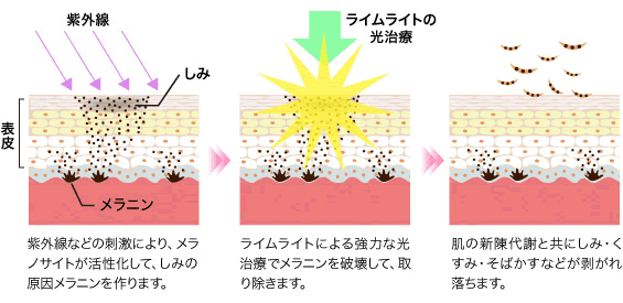 ライムライトの光治療